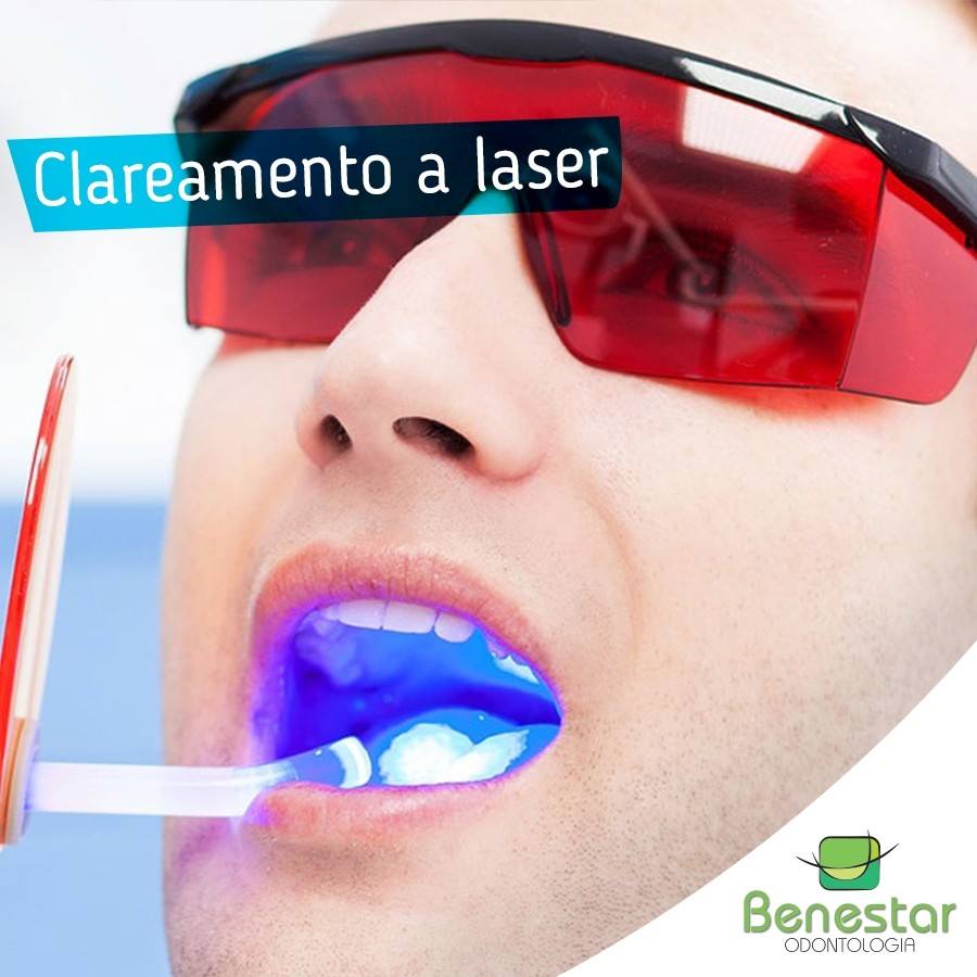 Clareamento a Laser e seus resultados