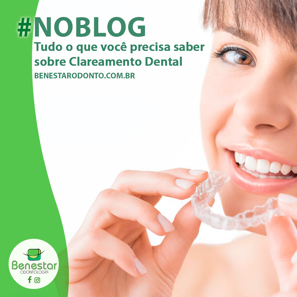 Clareamento Dental: Tudo o que você precisa saber sobre esse procedimento!